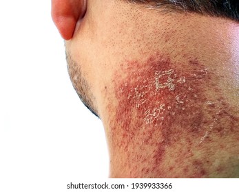 Neck Injury, Neck Rash, Bruising In The Neck Area,