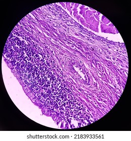 Neck Mass Cancer, Metastatic Adenocarcinoma, Show Skin, Fatty Tissue, Grandular Component Of Cystic Teratoma Of Testis.