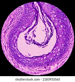 Neck Mass Cancer, Metastatic Adenocarcinoma, Show Skin, Fatty Tissue, Grandular Component Of Cystic Teratoma Of Testis.