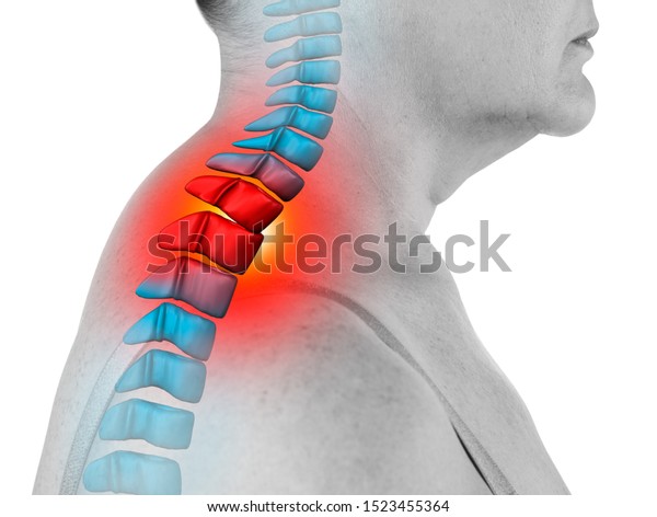 Neck pain, sciatica and
scoliosis in the cervical spine isolated on white background,
chiropractor treatment concept, painful area highlighted in red and
blue