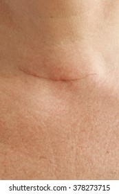 Neck Scar After Thyroid Glands Removal Surgery By A Woman Between 50 And 60 Years Old. Closeup