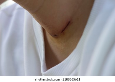 Neck Scar After Thyroid Surgery Without A Face