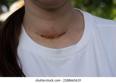 Neck Scar After Thyroid Surgery Without A Face