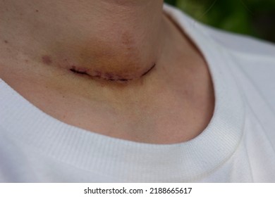 Neck Scar From Thyroid Surgery In A White T-shirt