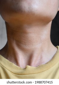 Neck swelling diagnosed as hyperthyroidism. Aging skin folds or skin creases or wrinkles at neck of Asian, Chinese young man. Front view.