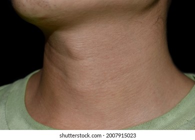 Neck Swelling Diagnosed As Hyperthyroidism. Aging Skin Folds Or Skin Creases Or Wrinkles At Neck Of Asian, Chinese Young Man.