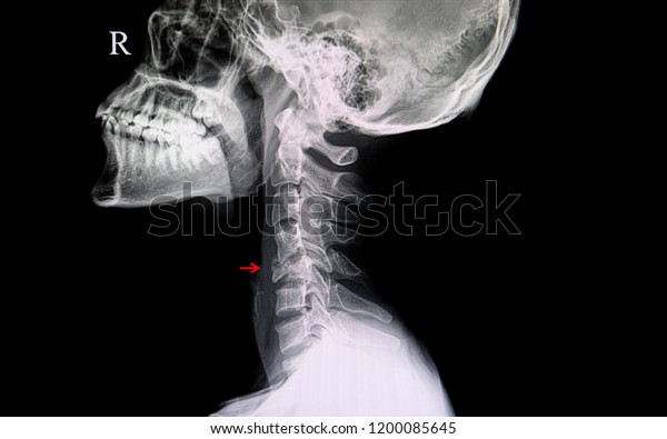 A neck xray image of a patient suffering from car\
accident showing bursting fracture of C 5 cervical spine. Fractured\
neck bone. Lateral neck film in traumatic and accidental injury.\
Fragmented bone.