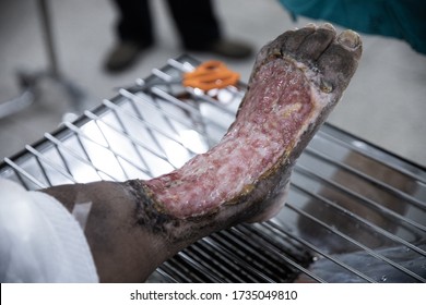 
Necrosis Of The Patient's Foot