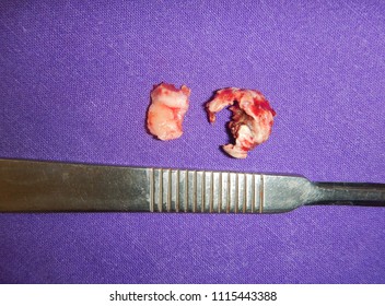 Necrotic Bone Pathology Lower Jaw Stock Photo Edit Now