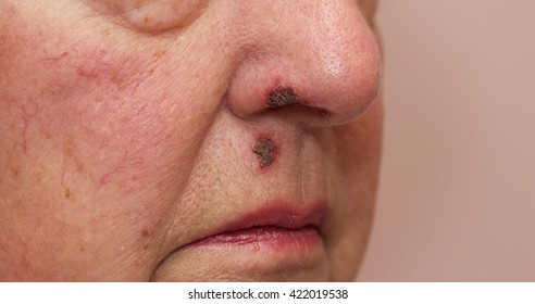 Necrotizing Impetigo In A Woman