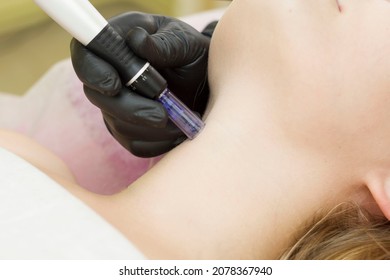 Needle mesotherapy. A cosmetologist performs needle mesotherapy on a woman's neck. A beautiful woman receiving a microneedle rejuvenation procedure.