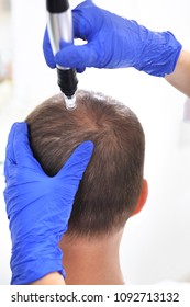 Needle Mesotherapy Of The Scalp. The Head Of A Man With Thinning Hair During Needle Mesotherapy