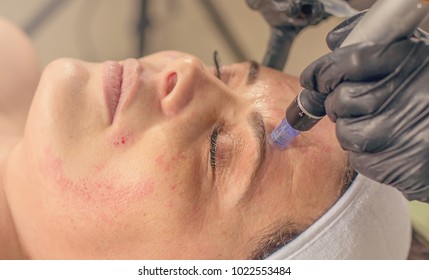 Needle Mesotherapy Treatment On A Woman Face. 