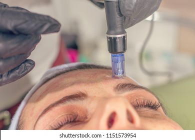 Needle Mesotherapy Treatment On A Woman Face. 