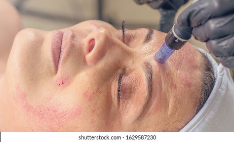Needle mesotherapy treatment on a woman face. 