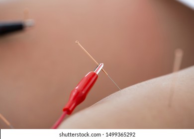      Needles are stimulated with electricity after insertion on the knee muscles