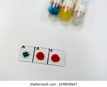 A Negative (-ve) Blood Type, One Of The Rare Blood Group In Worldwide. Blood Group And Rh Factor Testing By Slide Agglutination Method.