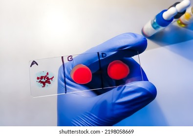 A Negative (-ve) Blood Type, One Of The Rare Blood Group In Worldwide. Blood Group And Rh Factor Testing By Slide Agglutination Method.