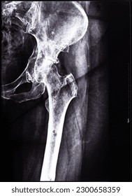 negative x-ray of junction of tibia and pelvis after healed of fracture of acetabular cavity