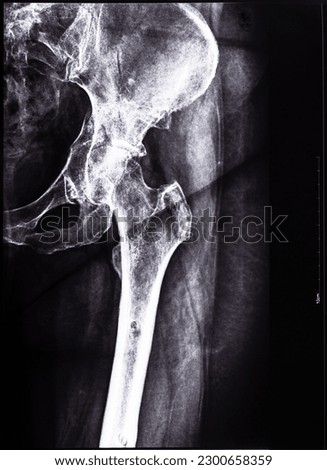 negative x-ray of junction of tibia and pelvis after healed of fracture of acetabular cavity