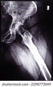 negative x-ray side view of junction of tibia and pelvis after healed of fracture of acetabular cavity