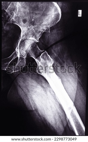 negative x-ray side view of junction of tibia and pelvis after healed of fracture of acetabular cavity