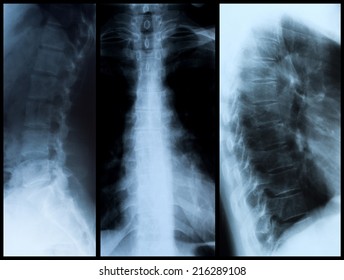 Рак позвоночника на рентгене фото