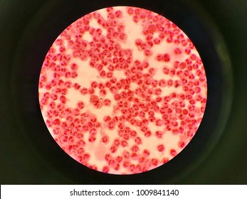 Neisseria Gonorrhoeae Infection