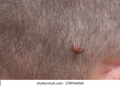A neoplasm on the scalp of a man. (Papilloma, condyloma, melanoma, wart). Selective focus,  Healthcare concept