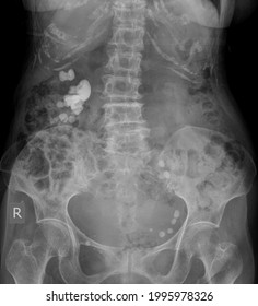 Nephrolithiasis Abdomen X Ray Renal Stone