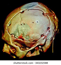 Neurosurgery, Craniotomy, CT