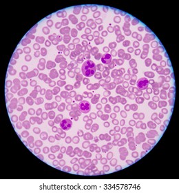 Стоковая фотография 665855161: Human Blood Smear Abnormal Red Blood ...