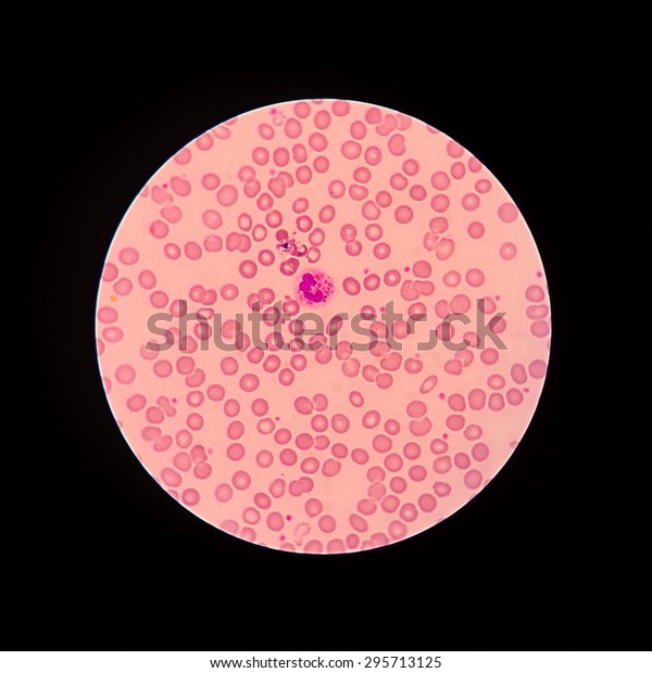 A neutrophil is a\
type of mature (developed) white blood cell that is present in the\
blood. White blood cells help protect the body against diseases and\
fight infections.