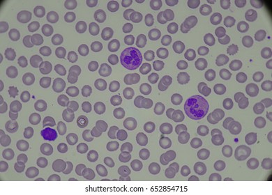 101 Hairy cell leukemia Images, Stock Photos & Vectors | Shutterstock