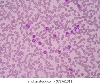 396 Neutrophilic Band Images, Stock Photos & Vectors | Shutterstock