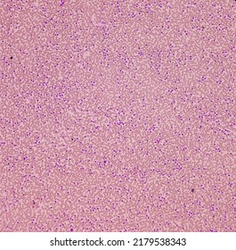 Neutrophilic Leukocytosis, Increase Total Count Of White Blood Cell And Increase Number Of Neutrophils Caused By Bacterial Infection, Granulocytes In The Blood, 10x View.