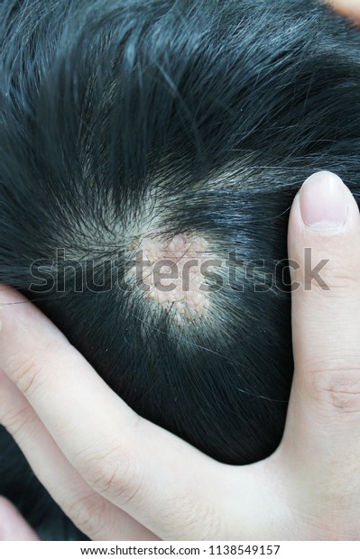 Nevus Sebaceous Scalp Localized Verrucous Patch Stock Photo 1138549157 ...