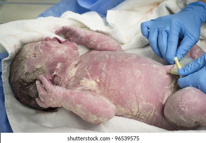 New born baby girl with clamped umbilical cord. She is only minutes old and her skin is covered in vernix caseosa.