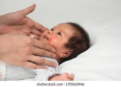 New Born Baby With Skin Rashes On The Cheeks, Inflamed Skin Of Children With Rash Problems, Health Concept