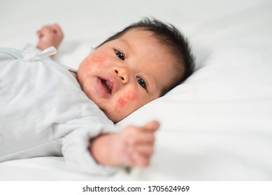 New born baby with skin rashes on the cheeks, inflamed skin of children with rash problems, Health concept