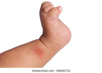new born  girl  and multiple mosquito bites leg   isolated white background