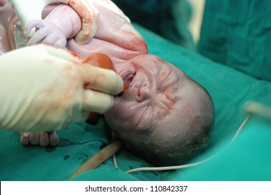 New Born Infant From Cesarean Section In Operating Theater.