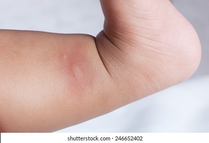 new born and multiple mosquito bites leg  white background