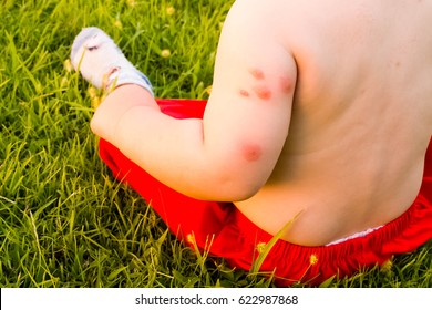 new born and multiple mosquito bites Allergy to insect bites Unrecognizable