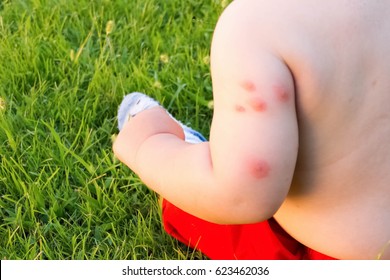 new born and multiple mosquito bites Allergy to insect bites