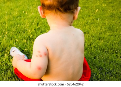 new born and multiple mosquito bites Allergy to insect bites
