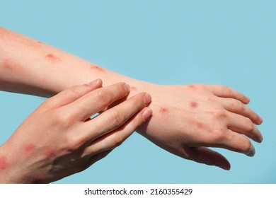 New disease dangerous over the world. Dengue fever. Patient with Monkey Pox. Painful rash, red spots blisters on the hand. Close up rash, human hands with Health problem. mpox disease symptom