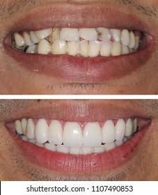 New Smile With Porcelain Crowns And Veneers