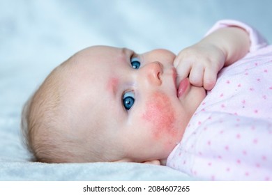 Newborn Baby With Allergic Reaction On Skin. Skin Rush, Detoxify.