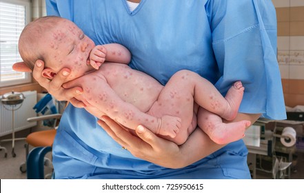 Newborn Baby With Chickenpox, Measles Or Rubella Lying In The Hands Of Doctor